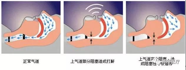 我國3000萬高血壓患者都有這毛??！你知道嗎？